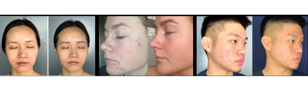 Before and After Acne